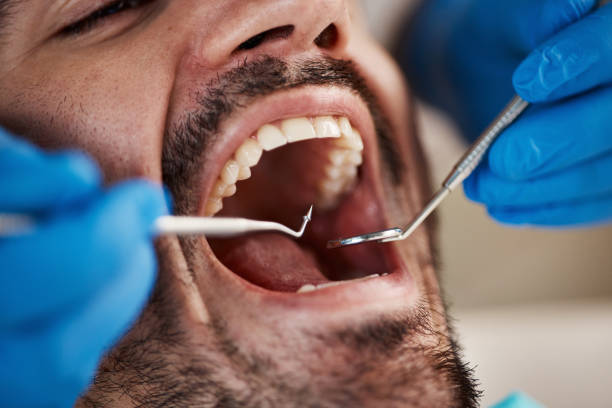 Best Emergency Wisdom Teeth Removal in Bangs, TX